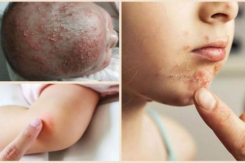 Viêm nang lông ở trẻ có nguy hiểm không?