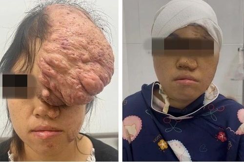 Người phụ nữ có khối u sụn xương sọ kích thước khổng lồ