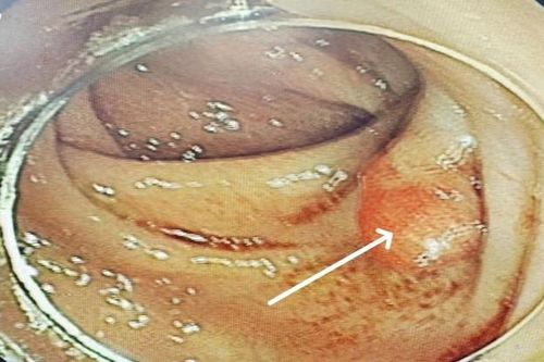 Bất ngờ 'thủ phạm' khiến người phụ nữ 58 tuổi đau bụng kéo dài