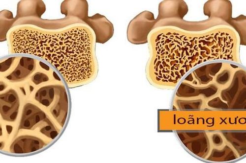 Loãng xương: Dự phòng và điều trị từ lối sống đến thuốc