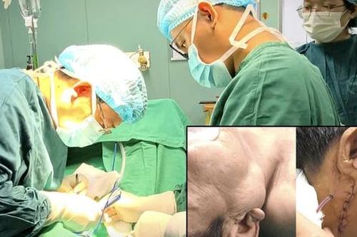 Hàm sưng to, cụ ông tái phát u tuyến nước bọt sau gần 10 năm