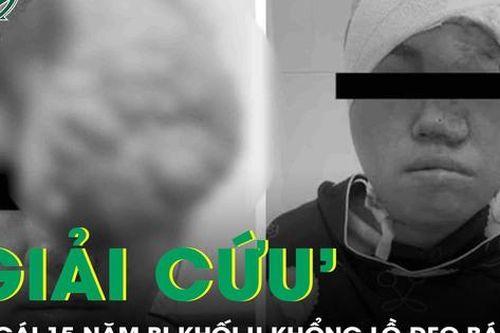 Giải cứu khuôn mặt cô gái sau 15 năm mang khối u khổng lồ