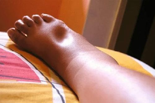 Phù quanh mắt cá chân có phải dấu hiệu của bệnh tim?