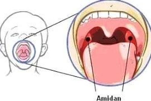 Liệu pháp tự nhiên phòng chữa viêm amiđan