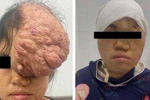 Khối u khổng lồ khiến khuôn mặt cô gái biến dạng suốt 15 năm