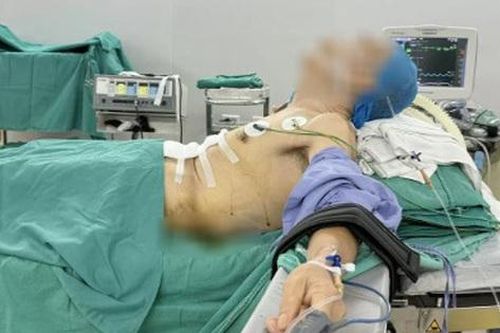 Ca mổ đặc biệt: Phẫu thuật ung thư dạ dày cho bệnh nhân gù vẹo cột sống, lưng gập gần 90 độ