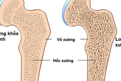 Loãng xương ở người cao tuổi dùng thuốc và chữa như thế nào?