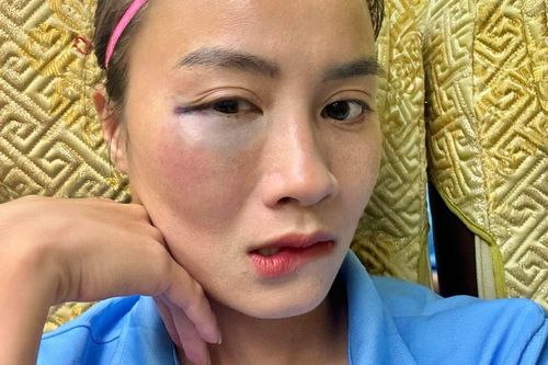 Gương mặt sưng vù của hot girl bóng đá sau va chạm