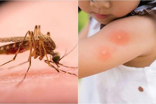 Cách xử lý côn trùng đốt