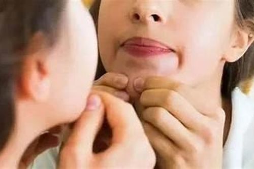 Suýt mất mạng vì tự nặn mụn