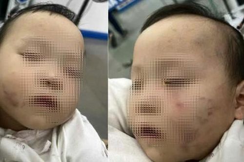 Tạm giữ bảo mẫu khiến bé gái 1 tuổi ở Bắc Ninh bị thương khi đi học