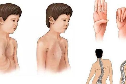 Không chỉ là dáng cao gầy, tay chân dài bất thường: Hội chứng Marfan tiềm ẩn biến chứng tim mạch gây tử vong