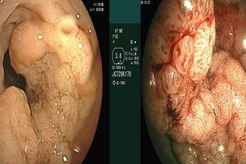 Người đàn ông ở Quảng Ninh phát hiện sớm ung thư trực tràng từ dấu hiệu nhiều người Việt mắc phải