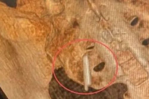 Đi khám sức khỏe, cô gái phát hiện vật dài khoảng 2cm trong cơ thể suốt 22 năm