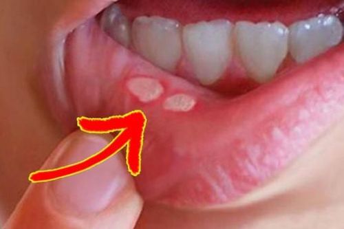 HIV ảnh hưởng đến sức khỏe răng miệng như thế nào?
