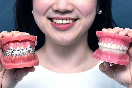 5 sai lầm khi niềng răng nhiều người Việt mắc phải
