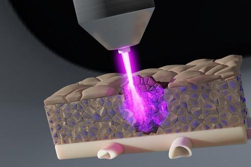 Tia plasma lạnh tiêu diệt tế bào ung thư ẩn sâu