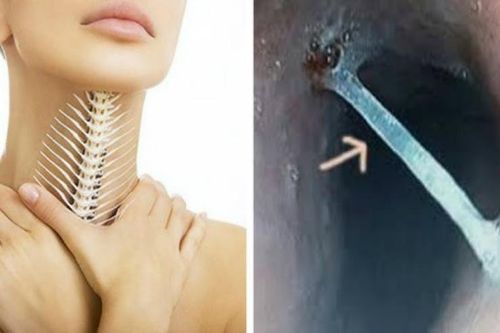 Mẹo chữa hóc xương cá bằng cách súc miệng