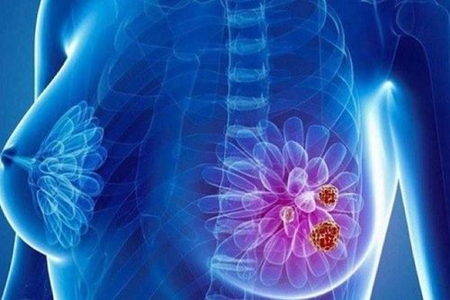 Bạch cầu trung tính có thể khiến ung thư vú phát triển và lan rộng