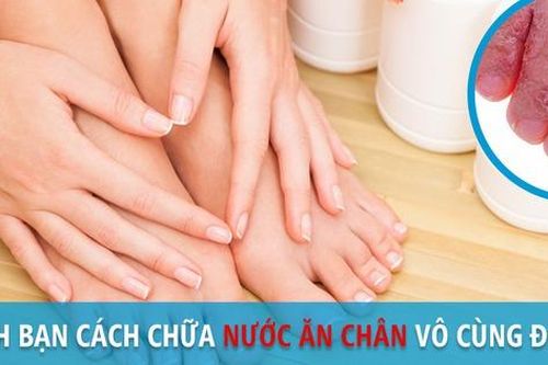 Nước ăn chân - Dùng thuốc và các phương pháp chữa trị tại nhà