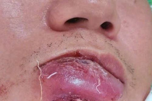 Gánh hậu quả chỉ vì chủ quan với nốt mụn ở mép môi