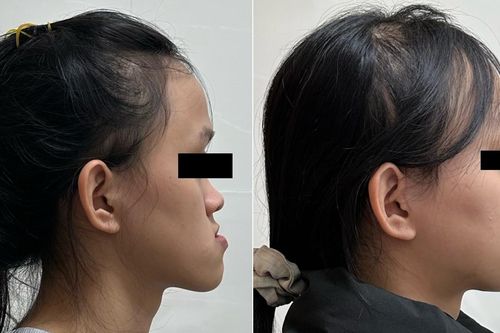 Điều trị móm (khớp cắn ngược) do xương hàm