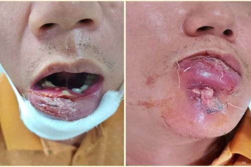 Người đàn ông 40 tuổi nhập viện với phần môi sưng tấy vì mắc sai lầm phổ biến