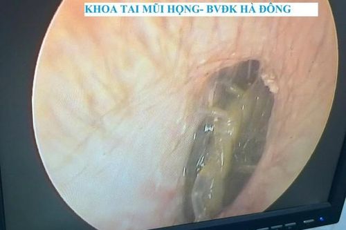 Bị rết sống chui vào tai, người đàn ông 33 tuổi ở Ninh Bình đau đớn nhập viện