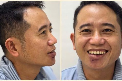 Tự điều trị mụn, nam bệnh nhân nhập viện vì áp xe sưng to vùng môi dưới