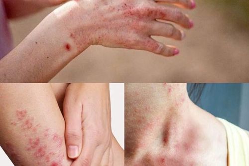 Thuốc điều trị viêm da trong mùa mưa