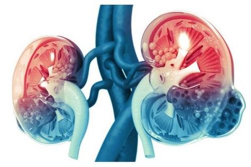 Phát hiện chấn thương thận qua 3 dấu hiệu điển hình