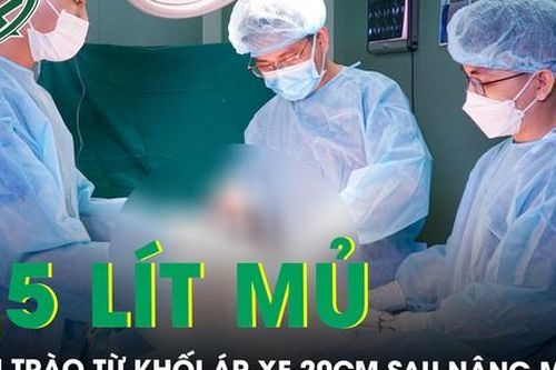 Bác sĩ choáng với khối áp xe khổng lồ sau nâng vòng ba, phải dùng máy hút 2,5l mủ