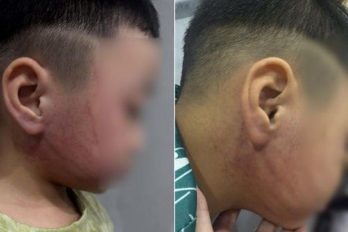 Bé 4 tuổi nghi bị giáo viên mầm non ở Hà Nội đánh bầm tím mặt