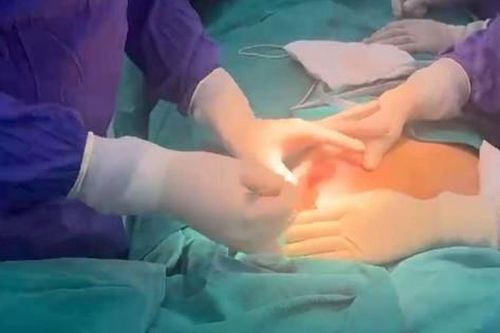 Sau tiêm nâng ngực 5 năm, nữ bệnh nhân bị biến chứng nặng