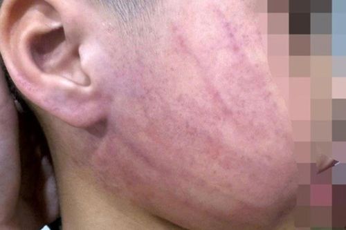 Công an vào cuộc điều tra vụ bé 4 tuổi nghi bị bạo hành tại trường mầm non ở Hà Nội
