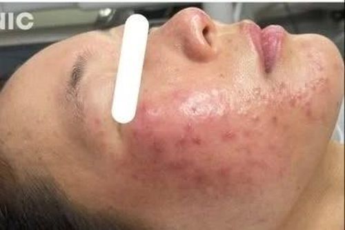 Da sần sùi, mũi sư tử... do trứng cá đỏ