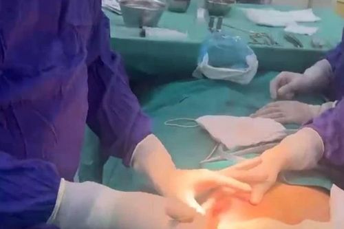 Ngực biến dạng, chảy mủ vì tiêm chất làm đầy từ 5 năm trước