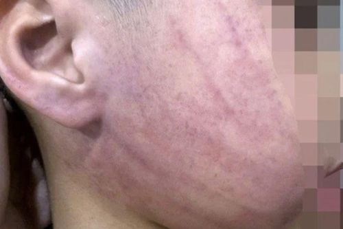 Vụ bé 4 tuổi nghi bị giáo viên mầm non đánh bầm tím mặt ở Hà Nội: Giáo viên phụ trách nói gì?
