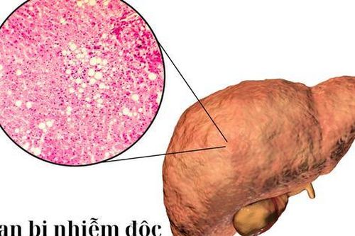 Gan nhiễm độc nguy hiểm hơn bạn nghĩ: 5 dấu hiệu thầm lặng nhiều người bỏ qua