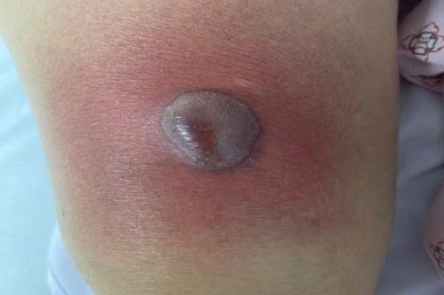 Những vết đỏ trên da đe dọa tính mạng