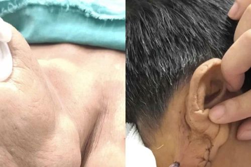 Cẩn thận u tuyến nước bọt lành tính biến đổi ung thư