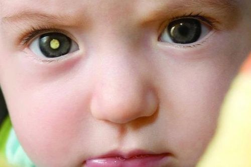 Phát hiện sớm ung thư nguyên bào võng mạc cứu thị lực cho trẻ