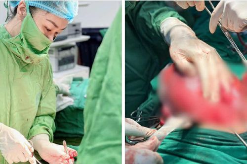 Sản phụ mang thai 34 tuần bị vỡ ruột thừa được cứu sống trong gang tấc