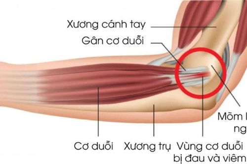 Không chỉ dân thể thao, ai cũng dễ mắc viêm gân khuỷu tay