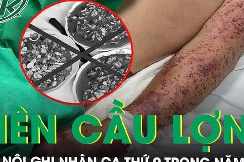Hà Nội ghi nhận ca nhiễm liên cầu lợn thứ 9 trong năm