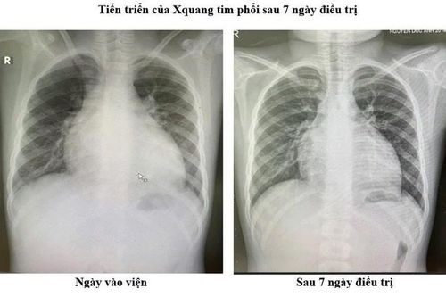 Điều trị thành công ca bệnh suy tim nặng ở trẻ em theo phác đồ mới