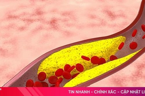 Các biến chứng khi bị xơ vữa động mạch