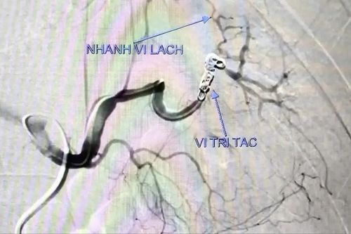 Cứu sống bệnh nhân nguy kịch do vỡ giả phình động mạch