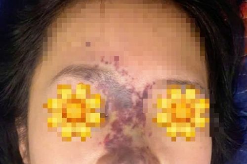 Tiêm filler trôi nổi, có người phải trải qua hơn 60 ca phẫu thuật để xử lý hậu quả