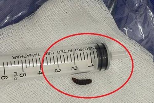 Phát hiện dòi sống ký sinh trong tai bé gái 14 tháng tuổi